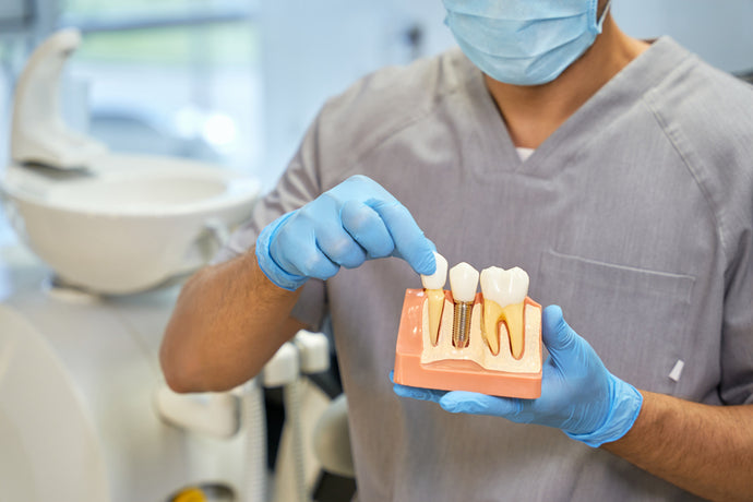 What Is The Cost Of Full-Mouth Of Dental Implants In 2024