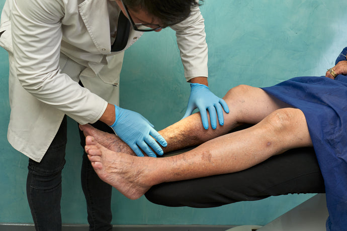 Revolutionizing Varicose Vein Treatment: Innovative Solutions Unveiled In The United States